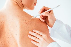 Лечение рака и меланомы кожи в клинике «Меланома Юнит»